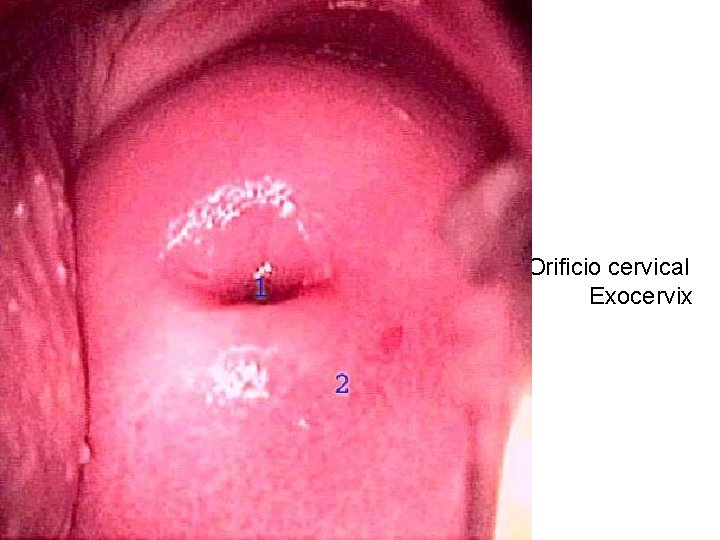 Orificio cervical Exocervix 