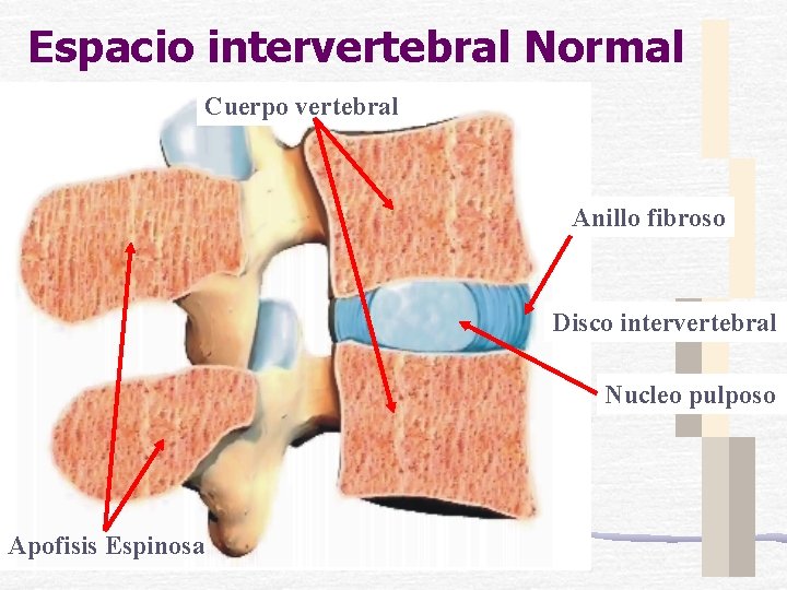 Espacio intervertebral Normal Cuerpo vertebral Anillo fibroso Disco intervertebral Nucleo pulposo Apofisis Espinosa 