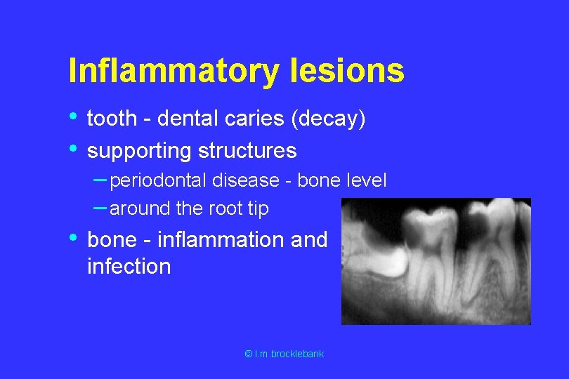 Inflammatory lesions • • tooth - dental caries (decay) supporting structures – periodontal disease Inflammatory lesions • • tooth - dental caries (decay) supporting structures – periodontal disease
