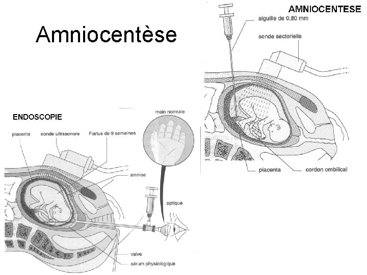 Amniocentèse 