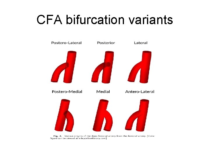 CFA bifurcation variants 