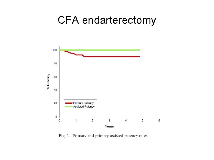 CFA endarterectomy 