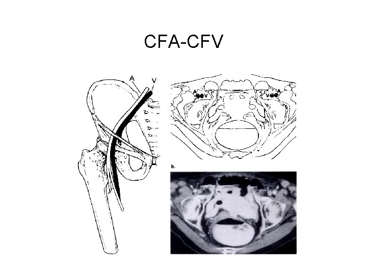 CFA-CFV 