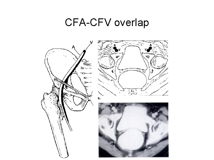 CFA-CFV overlap 