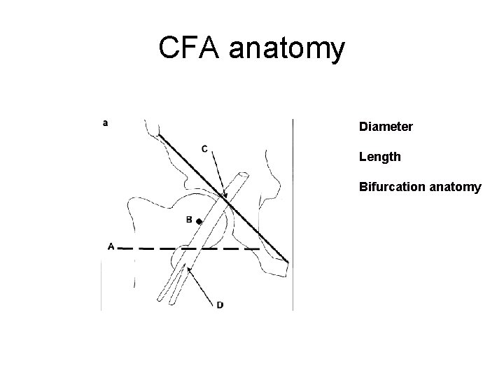 CFA anatomy Diameter Length Bifurcation anatomy 