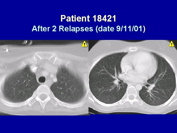 Patient 18421 After 2 Relapses (date 9/11/01) 