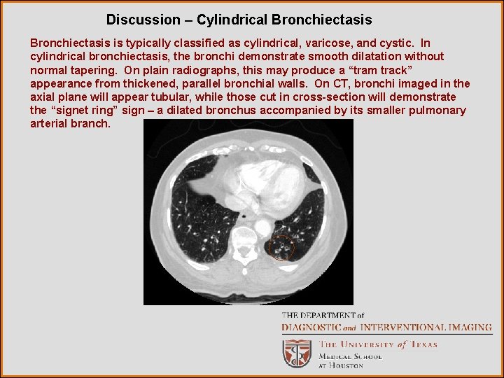 Discussion – Cylindrical Bronchiectasis is typically classified as cylindrical, varicose, and cystic. In cylindrical