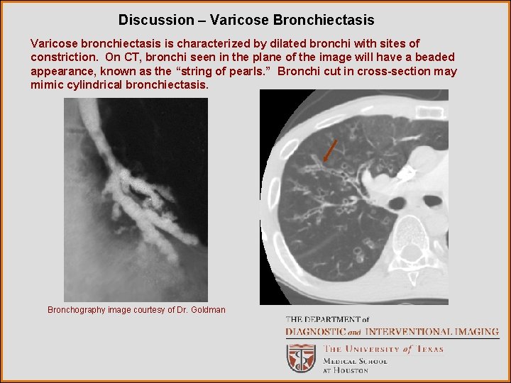 Discussion – Varicose Bronchiectasis Varicose bronchiectasis is characterized by dilated bronchi with sites of