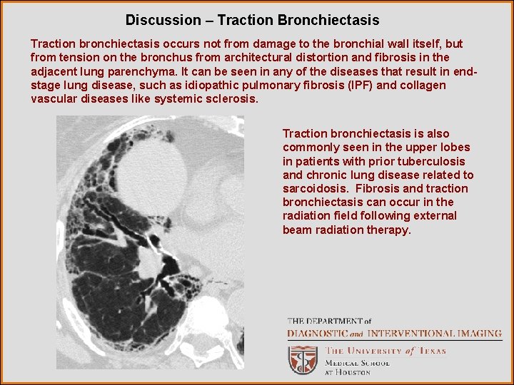 Discussion – Traction Bronchiectasis Traction bronchiectasis occurs not from damage to the bronchial wall Discussion – Traction Bronchiectasis Traction bronchiectasis occurs not from damage to the bronchial wall