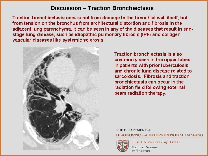 Discussion – Traction Bronchiectasis Traction bronchiectasis occurs not from damage to the bronchial wall