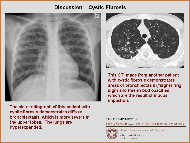 Discussion – Cystic Fibrosis This CT image from another patient with cystic fibrosis demonstrates