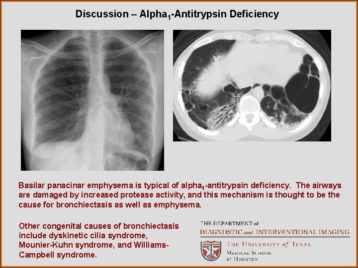Discussion – Alpha 1 -Antitrypsin Deficiency Basilar panacinar emphysema is typical of alpha 1