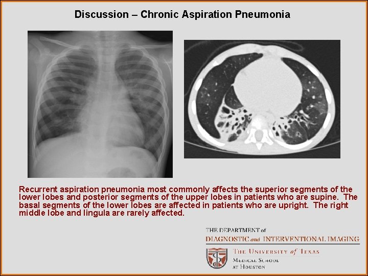 Discussion – Chronic Aspiration Pneumonia Recurrent aspiration pneumonia most commonly affects the superior segments