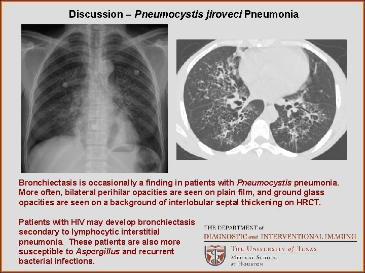 Discussion – Pneumocystis jiroveci Pneumonia Bronchiectasis is occasionally a finding in patients with Pneumocystis