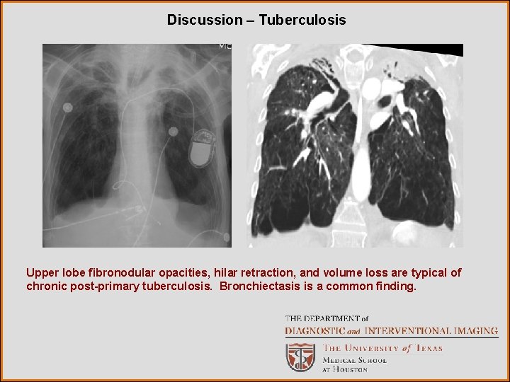 Discussion – Tuberculosis Upper lobe fibronodular opacities, hilar retraction, and volume loss are typical
