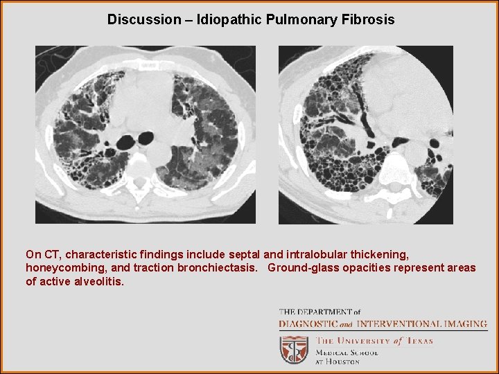 Discussion – Idiopathic Pulmonary Fibrosis On CT, characteristic findings include septal and intralobular thickening,