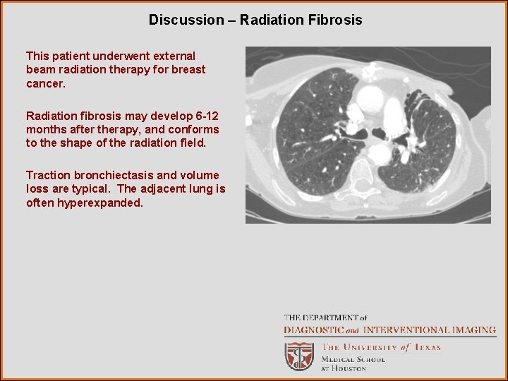 Discussion – Radiation Fibrosis This patient underwent external beam radiation therapy for breast cancer.