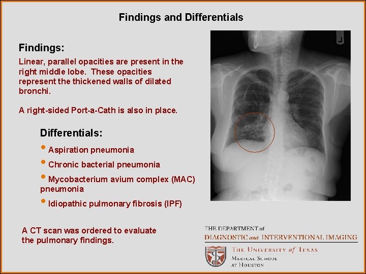 Findings and Differentials Findings: Linear, parallel opacities are present in the right middle lobe.