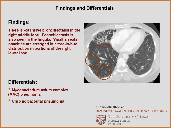 Findings and Differentials Findings: There is extensive bronchiectasis in the right middle lobe. Bronchiectasis