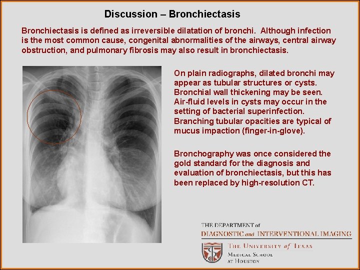 Discussion – Bronchiectasis is defined as irreversible dilatation of bronchi. Although infection is the