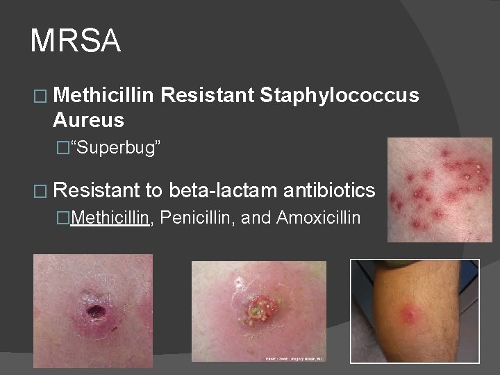 MRSA � Methicillin Resistant Staphylococcus Aureus �“Superbug” � Resistant to beta-lactam antibiotics �Methicillin, Penicillin, MRSA � Methicillin Resistant Staphylococcus Aureus �“Superbug” � Resistant to beta-lactam antibiotics �Methicillin, Penicillin,