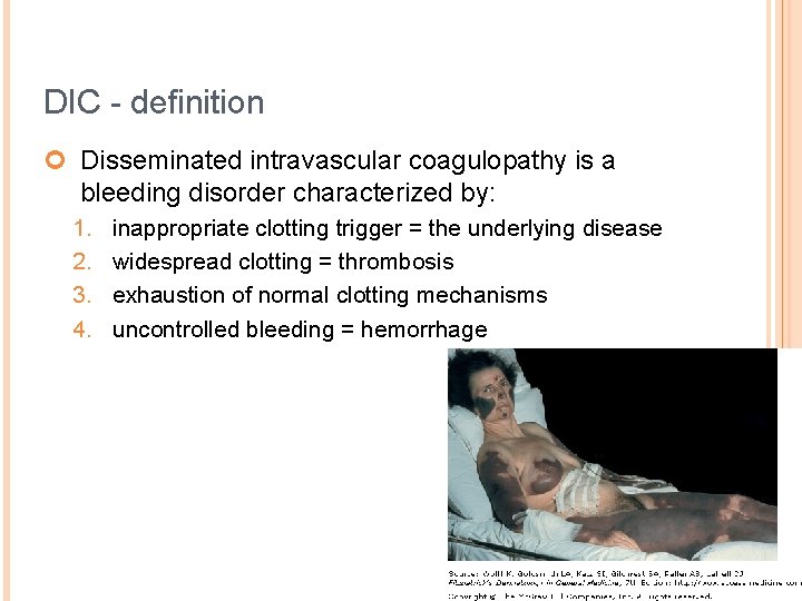 DIC - definition ¢ Disseminated intravascular coagulopathy is a bleeding disorder characterized by: 1.