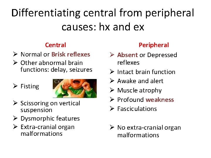 Differentiating central from peripheral causes: hx and ex Central Ø Normal or Brisk reflexes