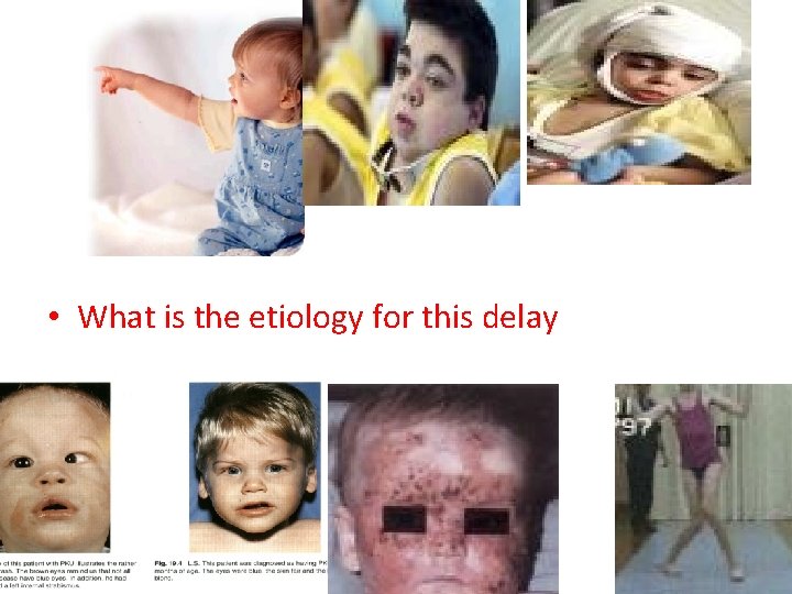  • What is the etiology for this delay • developmental delay ? ?