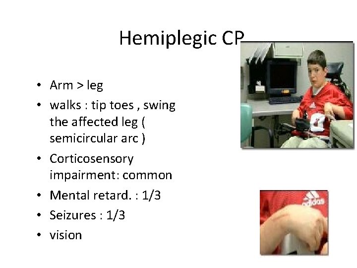 Hemiplegic CP • Arm > leg • walks : tip toes , swing the