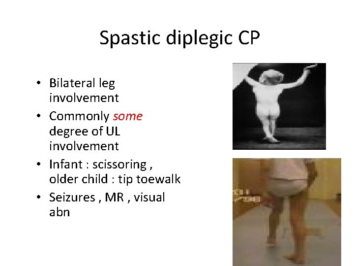 Spastic diplegic CP • Bilateral leg involvement • Commonly some degree of UL involvement