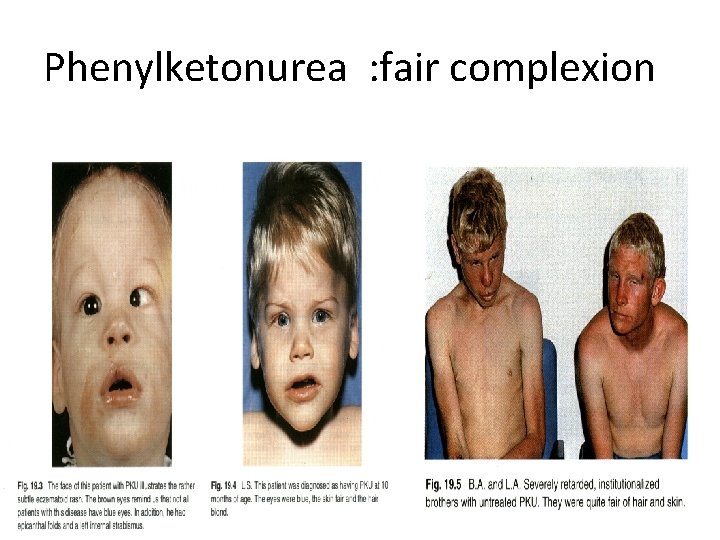 Phenylketonurea : fair complexion 