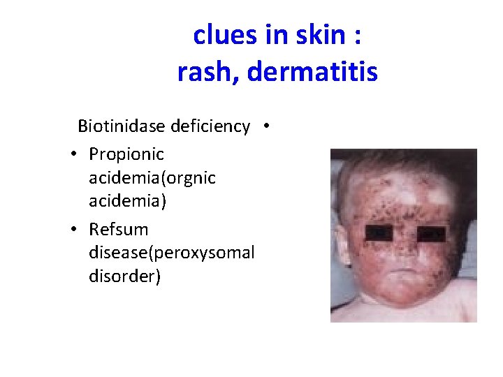 clues in skin : rash, dermatitis Biotinidase deficiency • • Propionic acidemia(orgnic acidemia) •