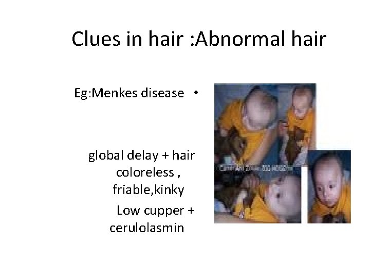 Clues in hair : Abnormal hair Eg: Menkes disease • global delay + hair