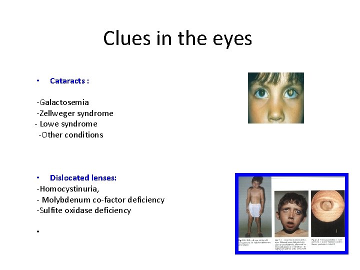 Clues in the eyes • Cataracts : -Galactosemia -Zellweger syndrome - Lowe syndrome -Other