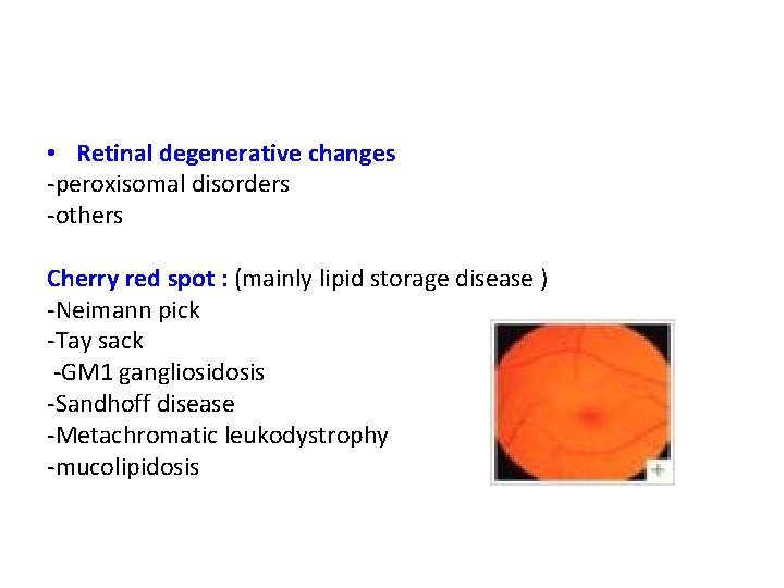  • Retinal degenerative changes -peroxisomal disorders -others Cherry red spot : (mainly lipid