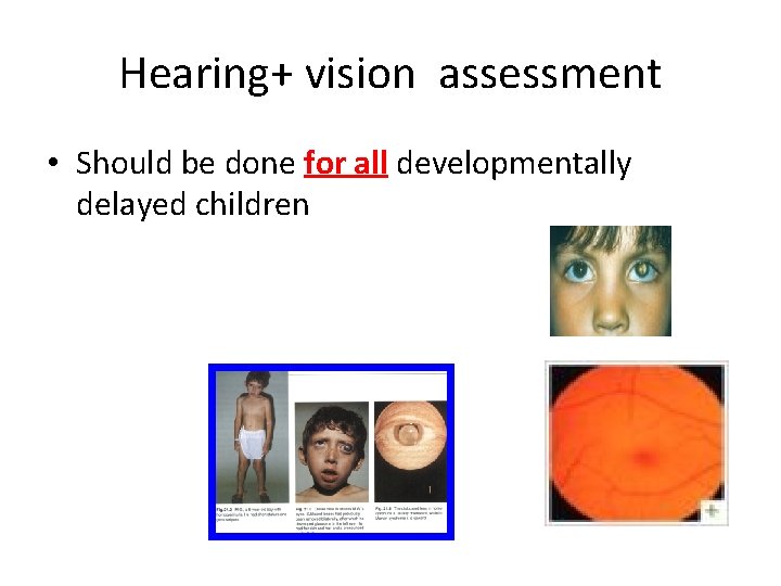 Hearing+ vision assessment • Should be done for all developmentally delayed children 