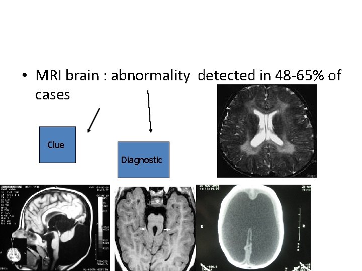  • MRI brain : abnormality detected in 48 -65% of cases Clue Diagnostic