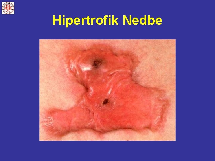 Hipertrofik Nedbe 