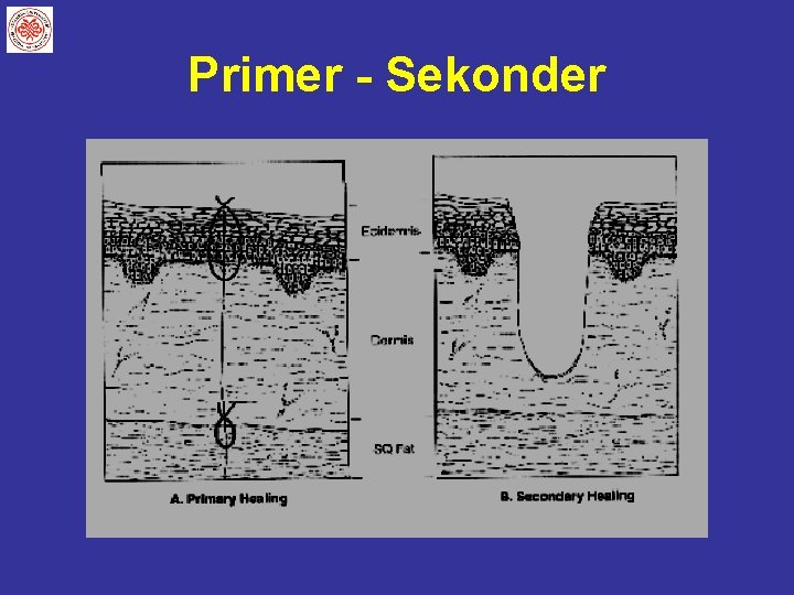 Primer - Sekonder 