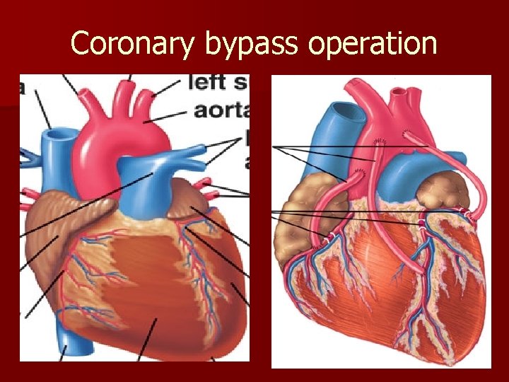 Coronary bypass operation 