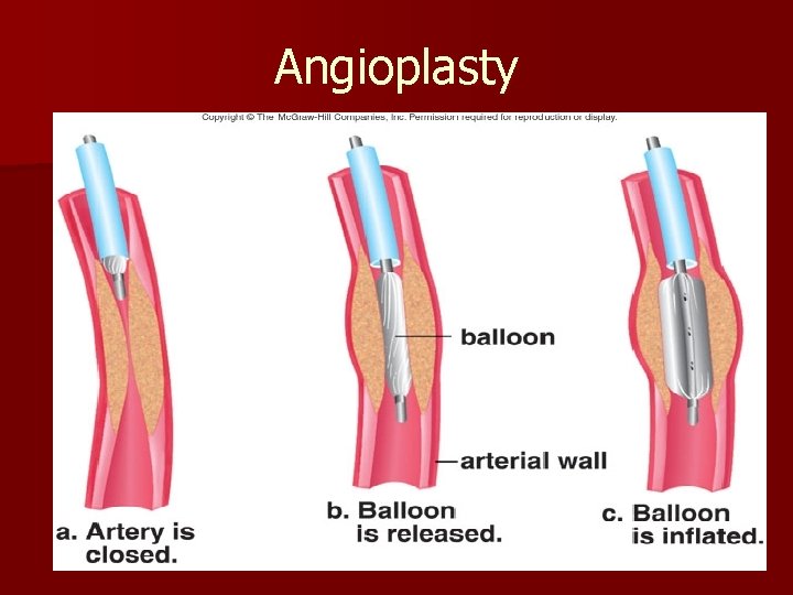 Angioplasty 