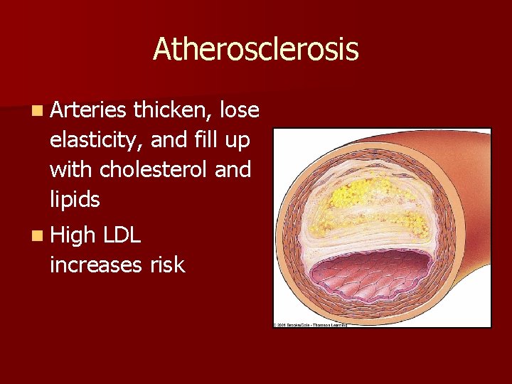 Atherosclerosis n Arteries thicken, lose elasticity, and fill up with cholesterol and lipids n