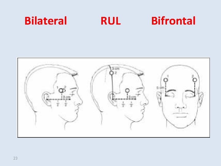 Bilateral 23 RUL Bifrontal 