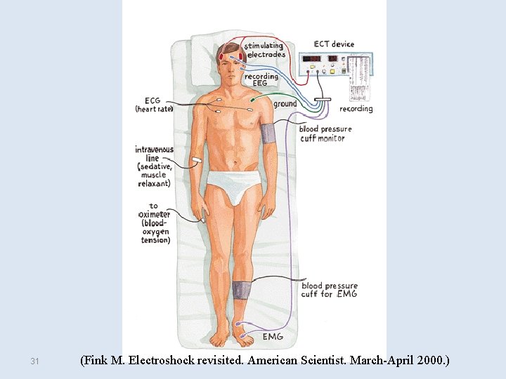 31 (Fink M. Electroshock revisited. American Scientist. March-April 2000. ) 