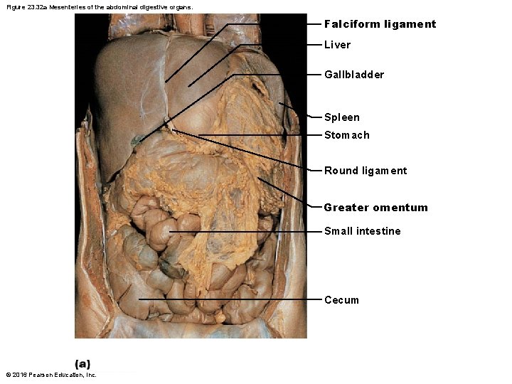 Figure 23. 32 a Mesenteries of the abdominal digestive organs. Falciform ligament Liver Gallbladder