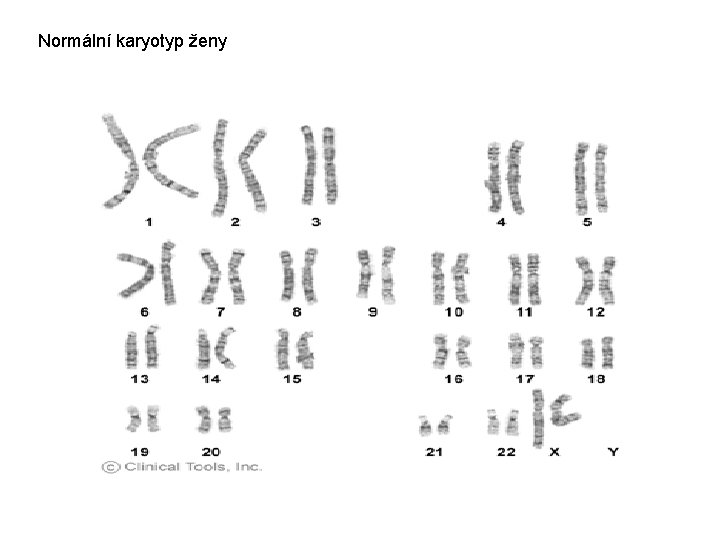 Normální karyotyp ženy 