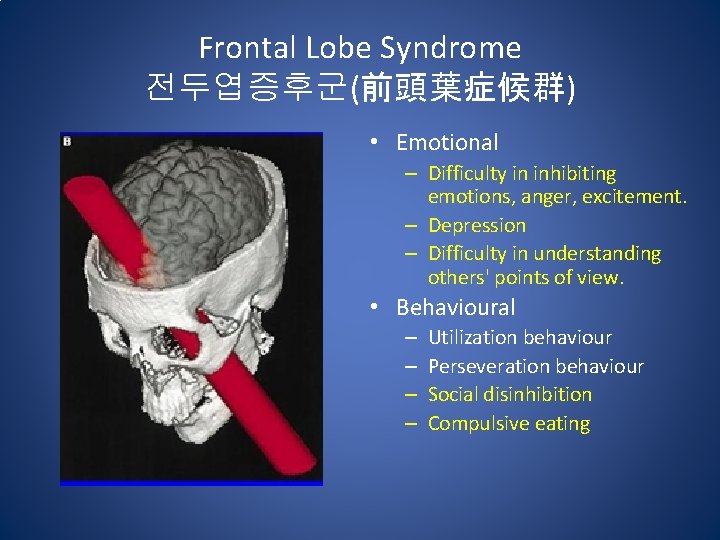 Frontal Lobe Syndrome 전두엽증후군(前頭葉症候群) • Emotional – Difficulty in inhibiting emotions, anger, excitement. –