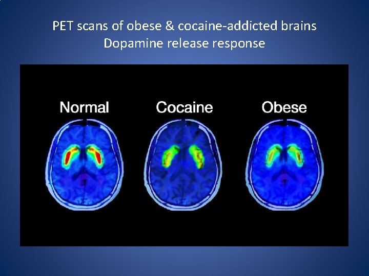PET scans of obese & cocaine‐addicted brains Dopamine release response 