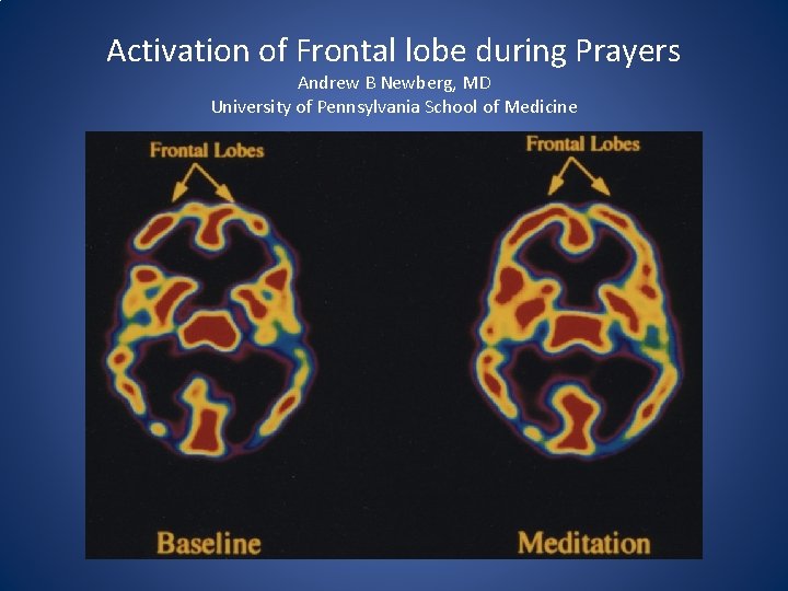 Activation of Frontal lobe during Prayers Andrew B Newberg, MD University of Pennsylvania School