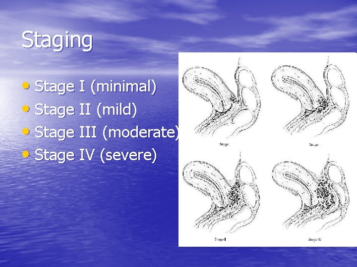 Staging • Stage I (minimal) • Stage II (mild) • Stage III (moderate) •